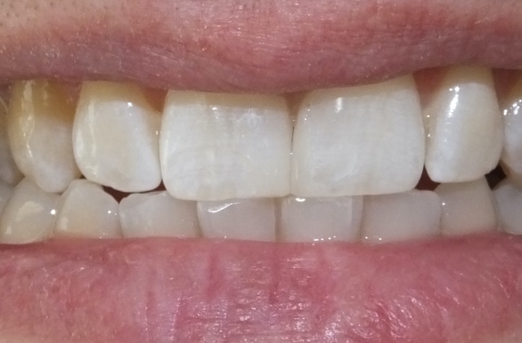 Additive Dentistry